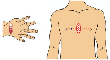 胸部圧迫処置の画像